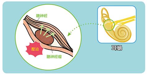 左耳一直耳鳴|耳鳴 ：發生的症狀、造成的原因、如何診斷與治療方。